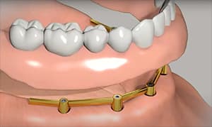 Stegprothese auf Implantaten: herausnehmbare Versorgung mit hohem Halt durch verbindenden Steg