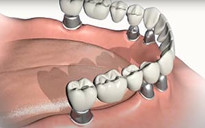 Implantatgetragene Teleskopprothese als hochwertige Alternative zur Steg-Verankerung