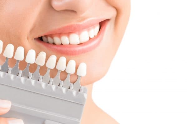 Bleaching-Farbskala zur Bestimmung der Zahnfarbe vor und nach der Aufhellung – Erfolgsmessung mit Farbringen