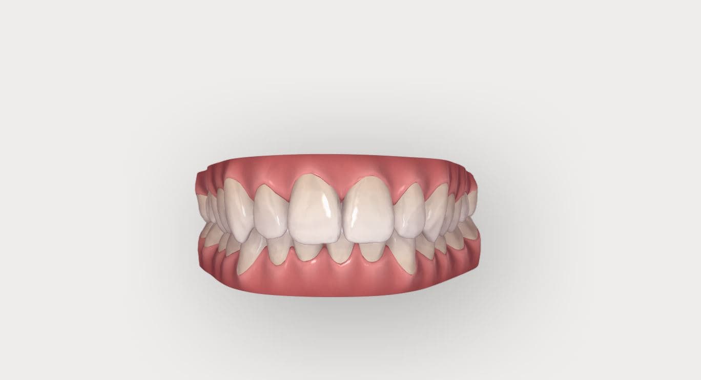 Invisalign Patientenfall: seitliche Ansicht des Bisses nach Abschluss der Aligner-Therapie mit korrigierter Zahnstellung