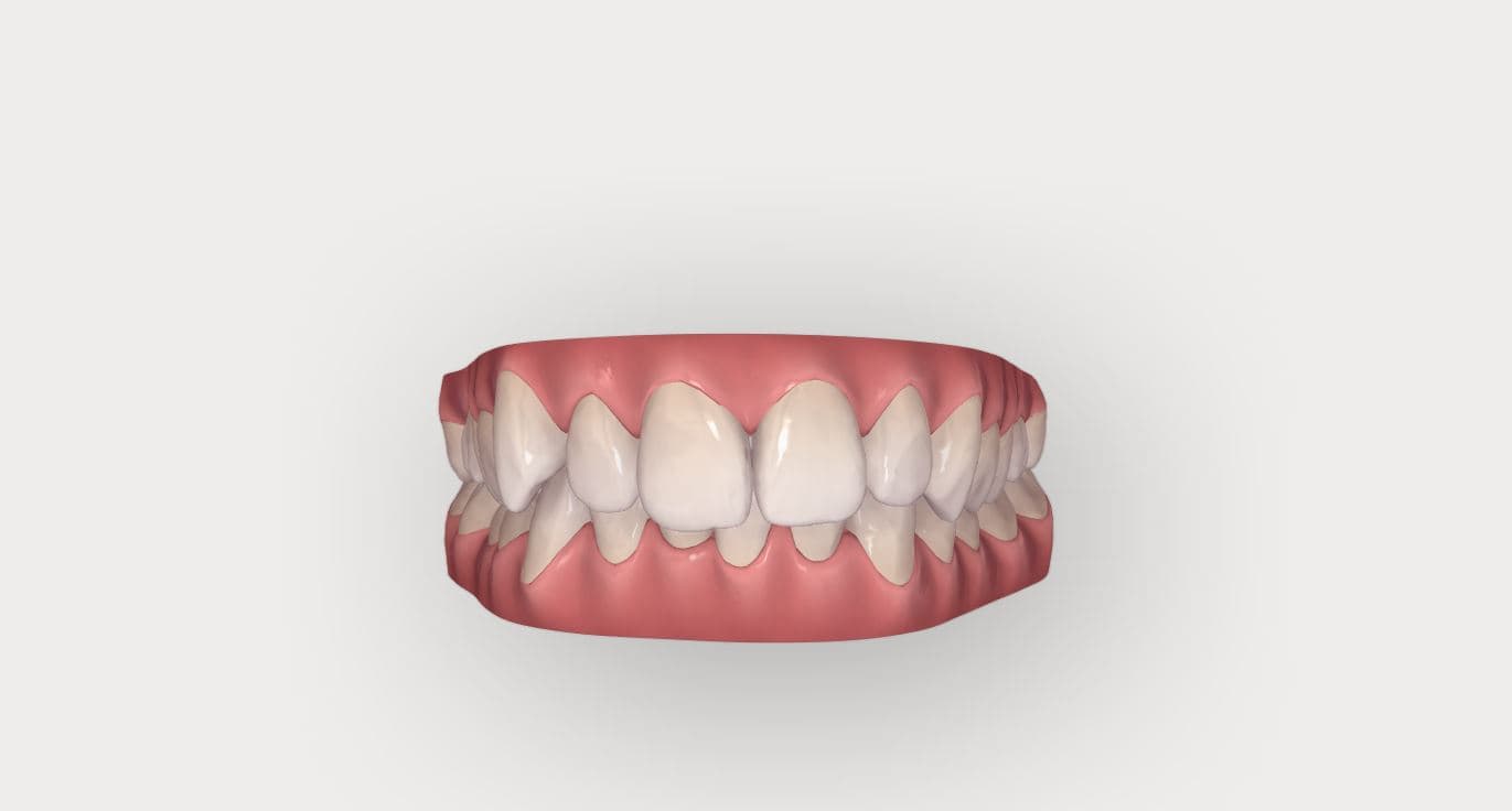 Invisalign Patientenfall: seitliche Ansicht des Bisses zu Behandlungsbeginn mit Fehlstellungen