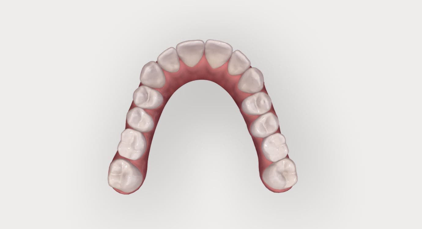 Invisalign Patientenfall: okklusale Aufsicht auf den Oberkiefer nach Abschluss der Aligner-Therapie