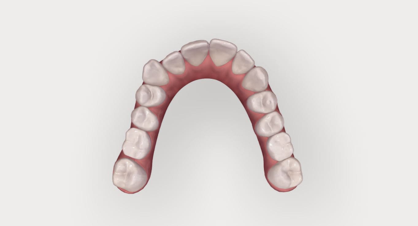 Invisalign Patientenfall: okklusale Aufsicht auf den Oberkiefer zu Behandlungsbeginn