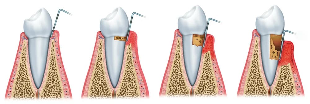 Plaque-Ablagerungen in der Zahnfleischtasche bei Gingivitis – Entzündung beginnt auf den Kieferknochen überzugreifen