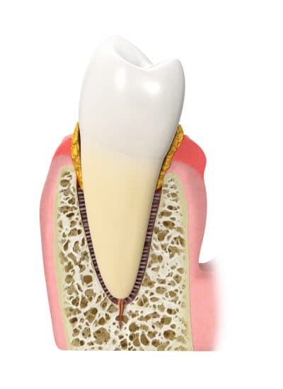 Anatomische Darstellung eines Zahnes mit Plaque- und Zahnsteinablagerungen am Zahnhals und beginnendem Knochenabbau bei Parodontitis