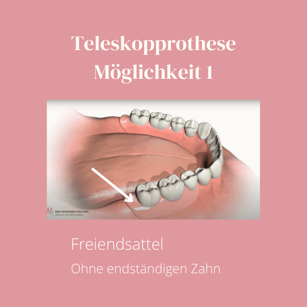Teleskopprothese mit Freiendsattel – herausnehmbare Doppelkronen-Versorgung mit Kunststoffsattel im hinteren Bereich