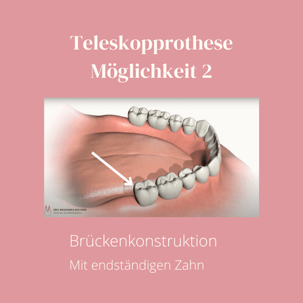 Teleskopprothese als filigrane Brücke gestaltet – ästhetische Doppelkronen-Versorgung ohne sichtbaren Sattel