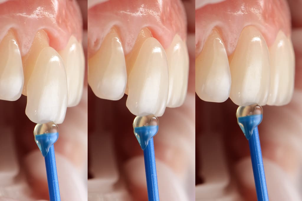 Anprobe eines Keramik-Veneers an einem Frontzahn vor der endgültigen adhäsiven Verklebung