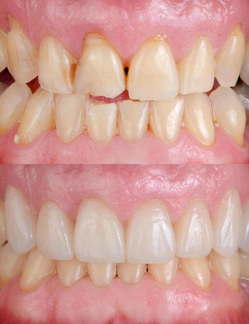 Veneers im Frontzahnbereich – Patientenfall vor und nach der Behandlung mit Keramik-Veneers im direkten Vergleich