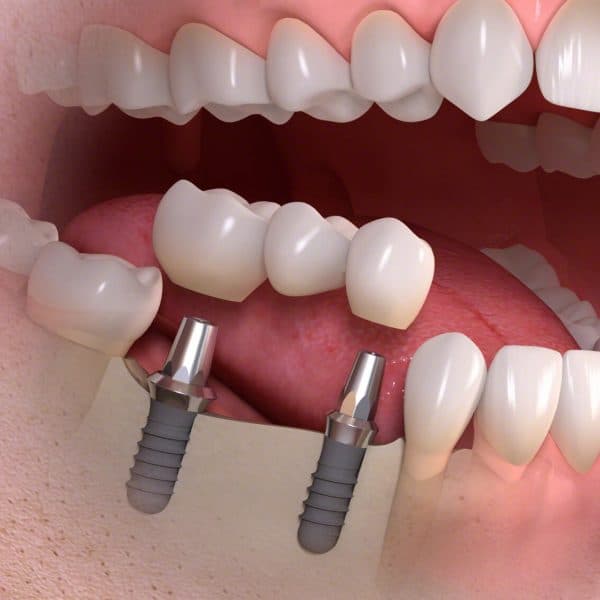 Implantatgetragene Brücke auf zwei Zahnimplantaten als Ersatz für mehrere fehlende Zähne im Seitenzahnbereich