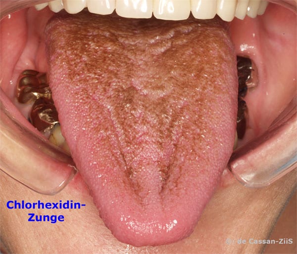 Intraorale Aufnahme einer herausgestreckten Zunge zwischen Wangenhaltern. Der Zungenrücken ist über die ganze Fläche bräunlich verfärbt, während Zungenspitze und Ränder ihre normale rosa Farbe behalten haben.