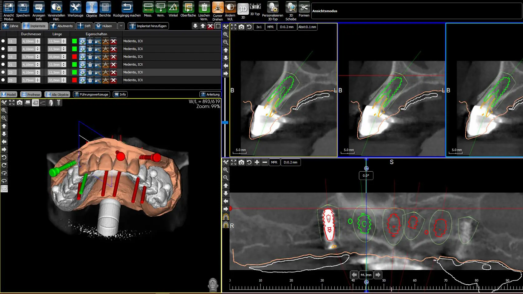 Implantatplanung am Computer auf Basis von DVT-Daten – dreidimensionale Positionierung eines Zahnimplantats im Kieferknochen