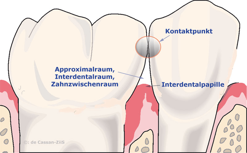 Schemazeichnung zweier benachbarter Backenzähne im Längsschnitt. Der Raum zwischen ihnen ist als Approximalraum, Interdentalraum und Zahnzwischenraum beschriftet. Die Stelle, an der sich beide Kronen berühren, ist als Kontaktpunkt markiert, das Zahnfleisch darunter als Interdentalpapille.