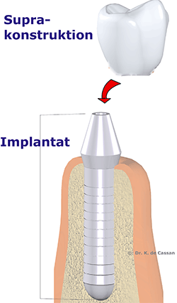 Schemazeichnung eines Zahnimplantats im Kieferknochen. Der schraubenförmige Teil im Knochen ist als Implantat beschriftet, die darüber schwebende Krone als Suprakonstruktion. Ein Pfeil zeigt, wie die Krone aufgesetzt wird.