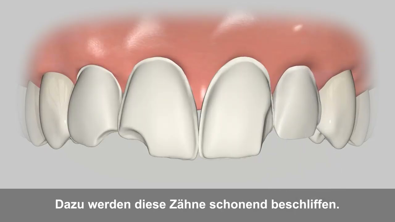 Vorschaubild: Veneers