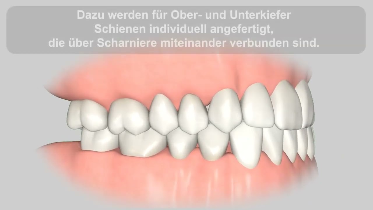 Vorschaubild: Schnarchschiene