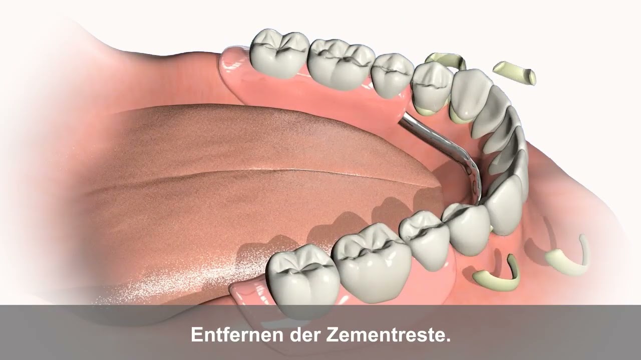 Vorschaubild: Teleskopprothese