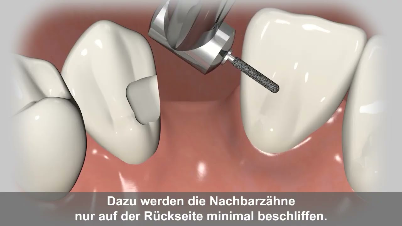Vorschaubild: Adhäsivbrücke (Klebebrücke)